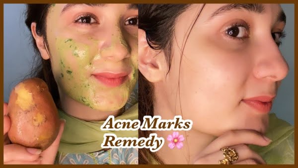 Acne Skin Care Marks Remedy