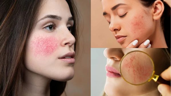 Rosacea Causes And Treatment Methods