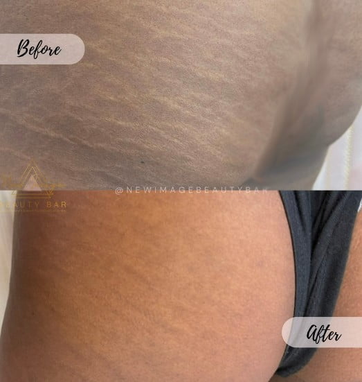 How To Get Rid Of Stretch Marks From Buttocks