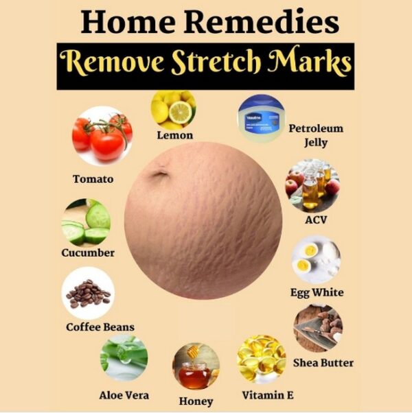 Red Stretch Marks, Natural Remedies.jpg